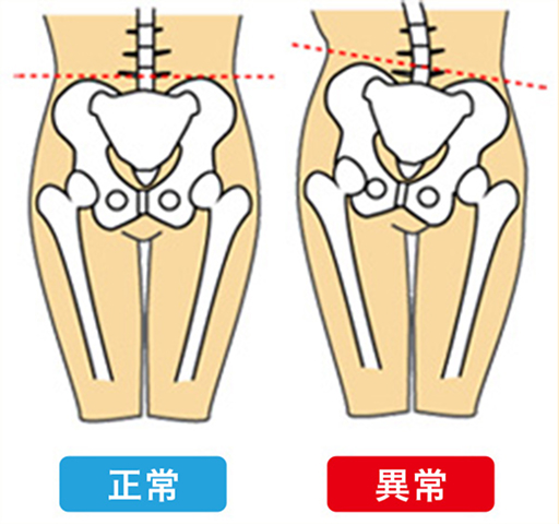ずれた骨盤イメージ